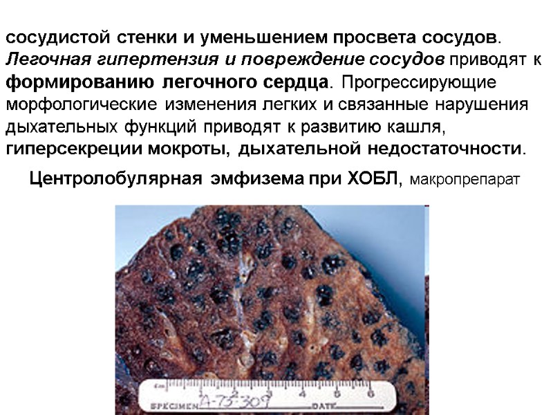 сосудистой стенки и уменьшением просвета сосудов. Легочная гипертензия и повреждение сосудов приводят к формированию